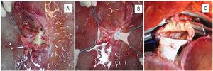 A) Vista posterior del hígado del paciente con PAF después de la perfusión durante la cirugía de banco. Se observa pérdida importante de la vena cava retrohepática y suprahepática y se aprecia la desembocadura de las venas suprahepáticas. B) Reconstrucción de cava retrohepática con cava inferior del donador fallecido. C) Anastomosis de la reparación vascular con la cava suprahepática de la primera receptora.