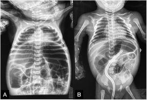 A)Dilatación de las asas intestinales. B)Mejoría del patrón restrictivo del tórax tras la colocación de las sondas orogástrica y transrectal.