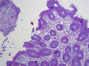 Reporte histopatológico de biopsias colonoscopia evidenciando mucosa de ciego con edema y glándulas tubulares con exudado fibrinoso en la superficie.