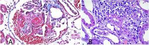 Reporte histopatológico de biopsias renales mostrando datos de glomerulonefritis con proliferación celular en patrón semilunar (A) y parénquima renal con infiltrado celular compatible con vasculitis (B).
