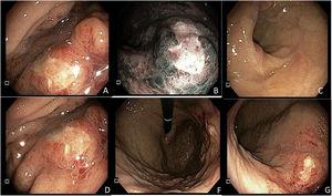 Endoscopia de vías digestivas altas con lesión de 10 mm x 10 mm de aspecto neoplásico en cuerpo hacia curvatura mayor. Figura 1A. Lesión en curvatura mayor bajo luz directa elevada con centro deprimido, de bordes irregulares, París 0-IIa + 0-IIc. Figura 1B. Lesión con superficie trabecular, con áreas ramificadas e irregulares, de color heterogéneo y patrón vascular con áreas que presentan vasos amputados bajo NBI (imagen de banda estrecha) en curvatura mayor del cuerpo gástrico. Figura 1C. Antro gástrico sin lesiones endoscópicamente evidentes. Figura 1D. Lesión visualizada desde la curvatura menor sin magnificación. Figura 1F. Retroflexión gástrica en la que se observa la lesión y fondo gástrico con mucosa normal. Figura 1G. Visión directa de todo el cuerpo gástrico.