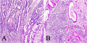 Imágenes microscópicas de muestras de adenocarcinoma gástrico de tipo intestinal. A) Patrón en encaje, con discreto infiltrado inflamatorio mononuclear peritumoral (magnificación 10x), recuadro inferior derecho: aumento 40x. B) Adenocarcinoma gástrico de tipo linfoepitelioma like, con formación de acúmulos linfoides (magnificación 10x), recuadro inferior derecho: aumento 40x; células neoplásicas rodeadas por células de aspecto linfoide. Tinción hematoxilina-eosina.