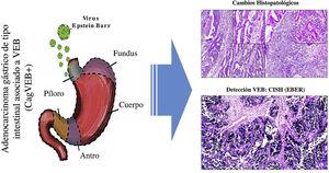 Resumen gráfico. La infección por virus de Epstein-Barr (VEB) es un factor etiológico de un subgrupo de CaG (CaGVEB). Este tipo de cáncer se diferencia por un patrón histológico en encaje, caracterizado por la conexión y fusión de las glándulas neoplásicas. Estos parámetros histopatológicos facilitan la selección de casos candidatos para estudios de tipo molecular, como la hibridación in situ, lo que puede contribuir al entendimiento de la enfermedad, y ser de utilidad para la evaluación de determinantes clinicopatológicas en regiones de alta incidencia de CaG.