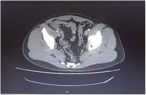 TC abdominal que muestra un segmento (de 15cm de extensión) con engrosamiento circunferencial de pared intestinal (6mm de grosor) del íleon terminal.