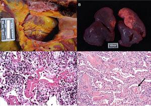 a. Derrame pericárdico serosanguinolento (40cc) en varón de 70 años. b. Pulmones con peso combinado de 1.550g. c. Mujer de 77 años que falleció por enfermedad de COVID a los 6 días de su ingreso. Ventilación mecánica. Imagen histológica del pulmón en la que se aprecia daño alveolar difuso con membranas hialinas, hiperplasia y descamación de neumocitos, fibroblastos e infiltrado inflamatorio mononuclear intersticial (HE, ×10). d. Varón de 83 años que falleció a los 11 días del ingreso. En la imagen se observan tabiques ampliados con ligero infiltrado inflamatorio y fibrosis. La flecha señala un vaso trombosado (HE, ×10).