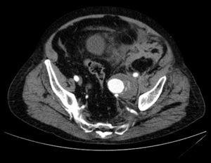 Imagen de la angioTAC del ingreso, con aneurisma gigante de arteria hipogástrica izquierda con signos de complicación.