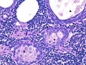 Hematoxilina-eosina 40×: los nidos epiteliales se componen de células basalioides (flechas) y, hacia el interior, bien células pavimentosas con queratinización corrugata (puntas), bien células sebáceas con citoplasma microvacuolado (estrellas). No se observa atipia.