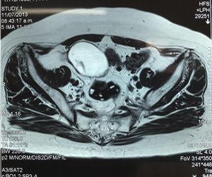 Resonancia magnética abdominal que evidencia quiste complejo de ovario derecho.