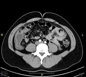 Tomografía abdominal que evidencia reacción inflamatoria apendicular.