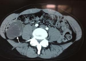 Tomografía abdominal que evidencia lesión quística en hemiabdomen inferior derecho que proyecta hacia retroperitoneo.