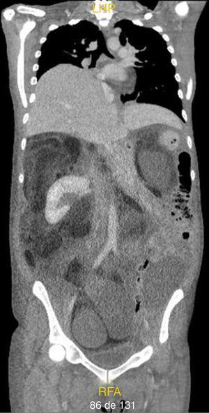 Corte coronal de la tomografía computarizada que muestra una extensa lesión retroperitoneal compatible con liposarcoma que envolvía completamente el riñón derecho y desplazaba las asas del intestino delgado y colon hacia el flanco y la fosa ilíaca izquierda.