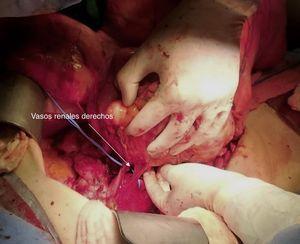 Se visualiza como el cirujano realizó una rotación medial del tumor, que envolvía completamente el riñón derecho, dejando expuestos los vasos renales para su ligadura y sección.