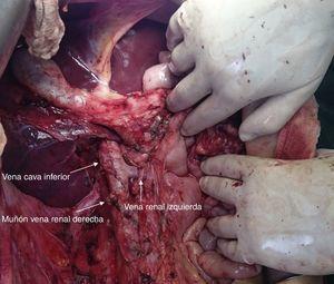 Lecho quirúrgico donde se aprecia el muñón de la vena renal derecha, la vena renal izquierda y la vena cava inferior.