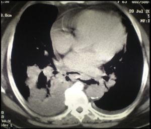 Tomografía de tórax donde se observa enfisema mediastinal y derrame pleural derecho.