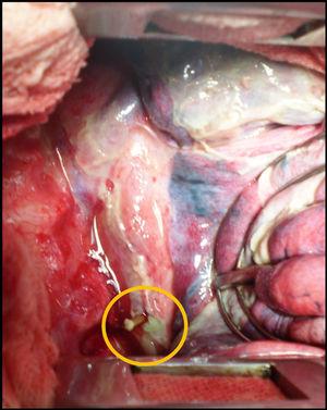 Se observa mediastinitis evolucionada por perforación del esófago torácico inferior por cuerpo extraño (mondadientes).