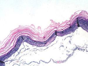 Corte histológico de vesícula biliar. Es evidente la necrosis transmural, con un denso infiltrado inflamatorio y zonas de hemorragia subyacentes (tinción de hematoxilina y eosina, 10×).