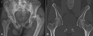 Caso 1. A) Radiografía de pelvis AP que muestra luxación de cadera izquierda. B) Imagen de TAC postreducción mostrando adecuada reducción sin lesiones asociadas.