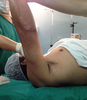 Examen físico del hombro derecho del paciente previo a la cirugía. Elevación de 95°.