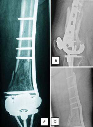 A. Radiografía anteroposterior postoperatoria de un montaje con placa LISS. B y C. Radiografías AP y lateral de fallo del implante.