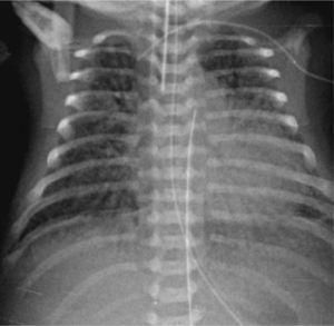 Rx de tórax demuestra extensas imágenes de relleno alveolar, con broncograma aéreo bilateral.