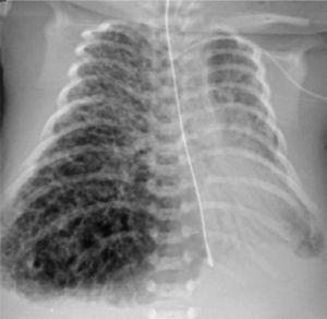Rx de tórax evidencia marcada asimetría de volumen pulmonar, con extenso enfisema intersticial a derecha y atelectasia a izquierda.