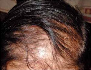 Alopecia androgenética femenina.