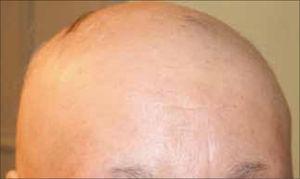 Alopecia areata más compromiso parcial de cejas.