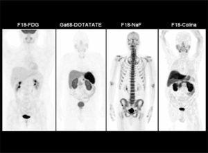 Distribución normal del radiotrazador en distintos tipos de PET/CT corporales. F18-FDG (mayor captación cerebral, acumulación cardiaca e intestinal variable, y excreción urinaria), Ga68-DOTATATE (alta captación en hipófisis, bazo, hígado y parénquima renal), F18-NaF (acumulación en el esqueleto y excreción urinaria) y F18-Colina (captación en glándulas salivales, hígado, parénquima renal y variable en intestino). El PET/CT óseo presenta una lesión hipercaptante en hueso iliaco derecho.