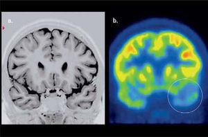 PET/CT cerebral con F18-FDG realizado a un paciente con epilepsia temporal izquierda. La RM cerebral fue normal (a). El PET muestra menor contraste temporal difuso izquierdo (b). El lóbulo temporal fue resecado resultando el paciente libre de crisis en el seguimiento postquirúrgico.