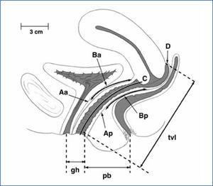 Puntos de referencia clasificación POP-Q J.L De Lancey. The hidden epidemia of pelvic floor dysfunction. Achiavable goals for improved prevention and treatment. Am J Obstet Gynecol 2005; 192:1488-95