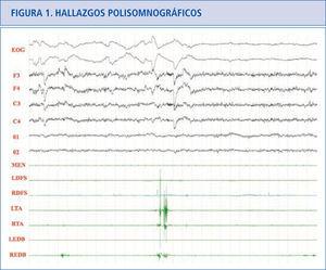Sueño REM normal donde podemos ver actividad fásica mínima en los dos tibiales anteriores y en el extensor breve de los dedos derecho. EOG: electrooculograma. F3: actividad EEG frontal izquierda, F4: actividad EEG frontal derecha. C3: actividad EEG central izquierda. C4: actividad EEG central derecha. 01: actividad EEG occipital izquierda. 02: actividad EEG occipital derecha. MEN: músculo mentalis. LFDS: flexor de los dedos superficial izquierdo. RFDS: flexor de los dedos superficial derecho. LTA: tibial anterior izquierdo. RTA: tibial anterior derecho. LEDB: extensor breve de los dedos izquierdo. REDB: extensor breve de los dedos derecho.