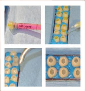 Uso de coronas sistema cad-cam en implantes osteointegrados | Revista ...