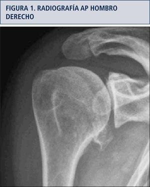 Radiografía anteroposterior de hombro derecho que demuestra osteofito inferior de la cabeza humeral mayor a 7mm.