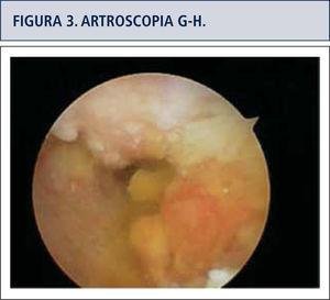 Visión artroscópica de articulación gleno-humeral que muestra sinovitis y denudación del cartílago articular.