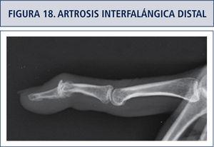 Severa artrosis interfalángica distal, Osteofitos por dorsa, indemnidad de la interfalángica proximal.