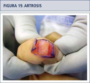 Exposición dorsal interfalángica distal para realizar la artrodesis, severa pérdida de cartílago articular.