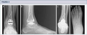 Evaluación de seguimiento a los 8 años (mismo paciente que en Fig. 2): Radiografías bajo carga realizadas con la misma técnica bajo fluoroscopía permiten un análisis preciso. A) vista ántero-posterior del tobillo; B); vista lateral del pie C), vista de alineación de Saltzman; D) vista ántero-posterior del pie.