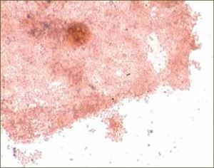 Clue cells Célula epitelial de vagina cubierta por numerosos cocobacilos, virtualmente adheridos a su pared.