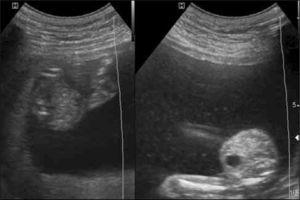 Embarazo gemelar monocorial con transfusión feto-fetal 18 semanas En el primer cuadro, feto con anhidramnios (stuck twin) y vejiga ausente y el segundo con polihidroamnios y vejiga presente.