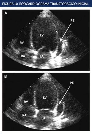 ECOCARDIOGRAMA TRANSTORÁCICO INICIAL Dilatación biventricular, función sistólica severamente disminuida con fracción de eyección estimada en 15% y derrame pericárdico moderado. Imagen apical de cuatro cámaras que muestra en diástole (A) y en sístole (B). LA: aurícula izquierda; LV: ventrículo izquierdo; PE: derrame pericárdico; RA: aurícula derecha; RV: ventrículo derecho. REF.21.