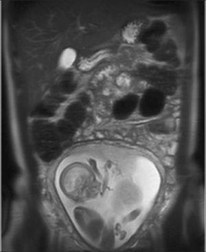 Imagen coronal HASTE de resonancia magnética del abdomen de paciente embarazada, segundo trimestre La adquisición rápida permite reconstruir imagen del abdomen completo en segundos.