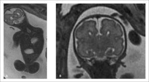 RMF paciente de 26 semanas con defecto amplio del hemidiafragma izquierdo que permite el paso de asas intestinales que ascienden y ocupan el hemitórax. Imagen coronal T2 (A) y parasagital izquierda (B).