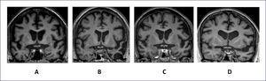 IMÁGENES DE RESONANCIA MAGNÉTICA NUCLEAR REPRESENTATIVAS DE CORTES CORONALES A LA ALTURA DEL QUIASMA ÓPTICO Se muestran ejemplos representativos de cortes coronales a la altura del quiasma óptico que evidencian el patrón de atrofia cerebral para DFTvc (A), APPvs (B), APPvnf (C) y APPvl (D). Nótese que DFTvc (A) muestra atrofia simétrica y marcada de los lóbulos frontales que se extiende a la parte anterior de los lóbulos temporales. La imagen de APPvs (B) muestra una atrofia evidente, asimétrica, de la parte inferior y anterior del lóbulo temporal, con cierto respeto del hipocampo. El patrón de atrofia en APPvnf, en cambio, muestra aumento del tamaño del valle silviano izquierdo a expensas de la atrofia de la ínsula, y giro frontal inferior. En la Figura D, se observa un caso con APPvl que también muestra expansión del valle silviano izquierdo, pero además atrofia en la región temporal superior.