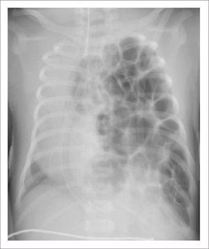 PACIENTE CON TRONCO ARTERIOSO Rx de tórax muestra gran hernia diafragmática izquierda con hipoplasia severa del pulmón ipsilateral.