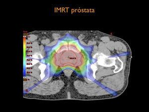 Distribución de dosis de radiación para tratamiento de cáncer de próstata con planificación con IMRT