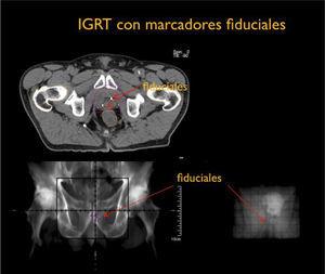 IGRT con marcadores fiduciales para localización de próstata
