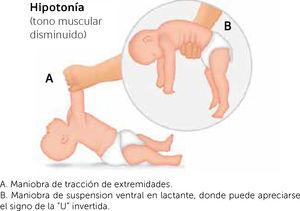 Maniobras para evaluar tono en recién nacidos y lactantes A. Maniobra de tracción de extremidades. B. Maniobra de suspension ventral en lactante, donde puede apreciarse el signo de la “U” invertida.
