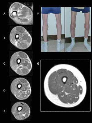 Miopatía relacionada con SEPN1 (SEPN1-RM), RM muscular a nivel de muslo A-E) Vista axial a diferentes niveles en el muslo de un joven con rigidez espinal y biopsia distrófica que revelan la ausencia de músculo semimembranoso (SM). F) Imagen de las piernas del paciente explorado en RM, mostrando una atrofia llamativa de los músculos sartorio (vista anteroposterior) y SM (vista posterior). G) Cortes axiales de un muslo de un control sano. Sartorius (S), gracilis (G), adductor magnus (AM), semimembranosus (SM), semitendinosus (ST), y biceps femoris (BF). (Hankiewicz et al. Whole-body muscle magnetic resonance imaging in SEPN1-related myopathy shows a homogeneous and recognizable pattern. Muscle Nerve. 2015 Nov;52(5):733).
