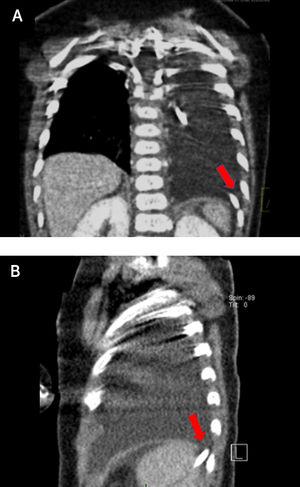 Reconstrucciones de TC de tórax baja dosis (a) coronal y (b) sagital. Se evidencia defecto diafragmático póstero-lateral izquierdo y paso del catéter a través de este (flechas).
