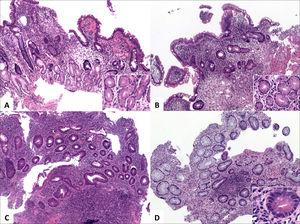 Histología En La Enfermedad Inflamatoria Intestinal | Revista Médica ...